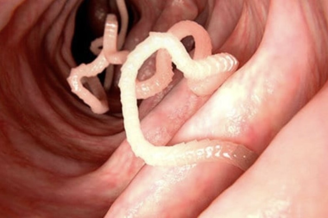 I PARASSITI DEL CORPO UMANO :NEMICI SILENZIOSI .
