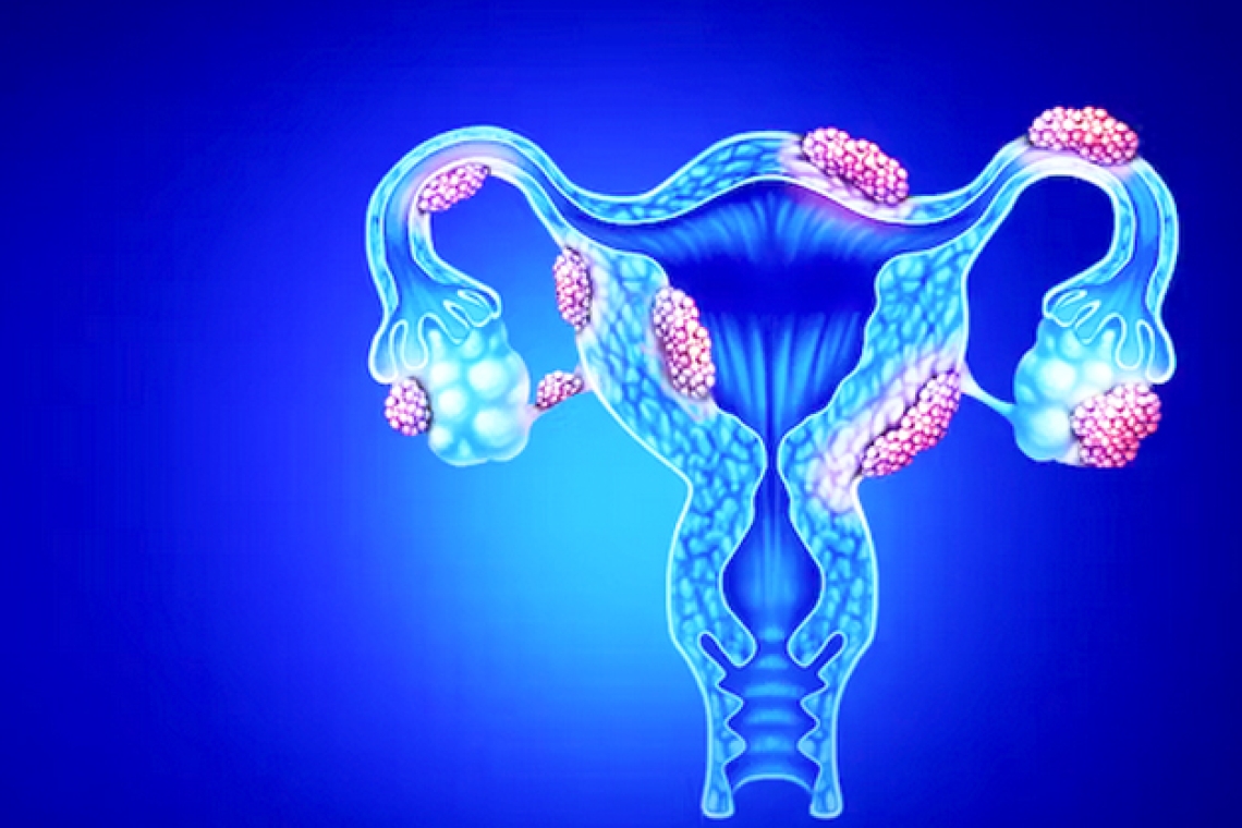 ENDOMETRIOSI / ADENOMIOSI NELLA PSICOBIOLOGIA